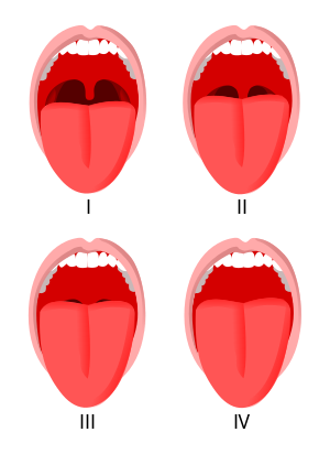 This image shows examples of the 4 classifications of the modified Mallampati score