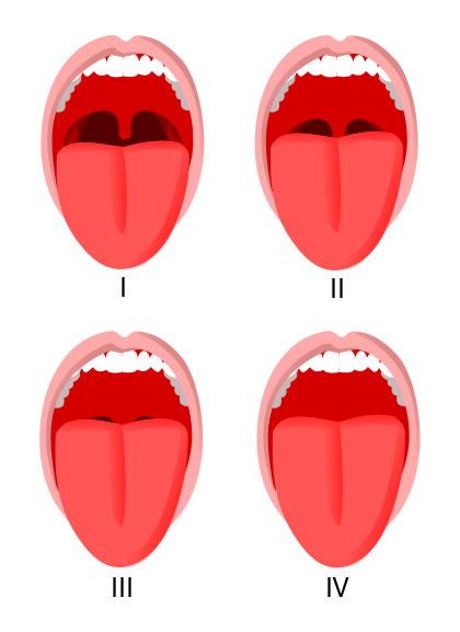 File:Mallampati score.svg