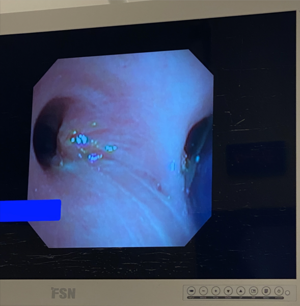 File:Muco tumor.png